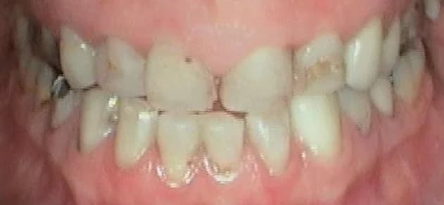 Case 01 before — Porcelain Veneers
