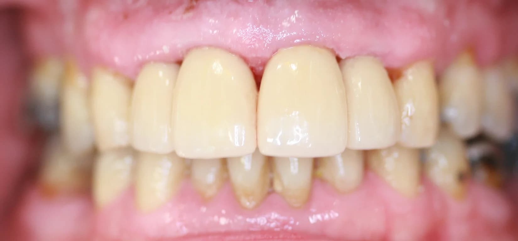 Case 02 after — Smile Makeover