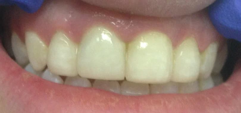 Case 03 after — Teeth Whitening