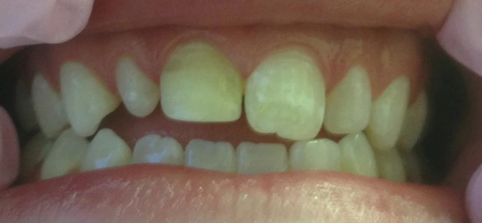 Case 03 before — Teeth Whitening