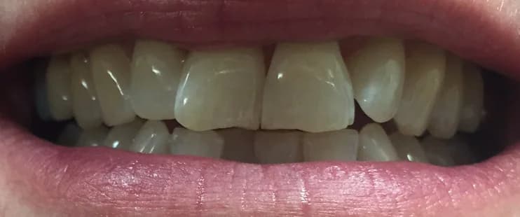 Case 04 before — Composite Bonding